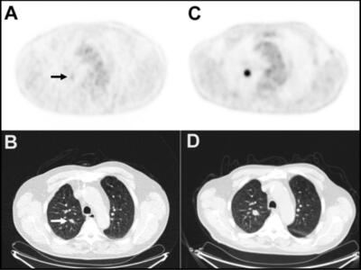 Imaging scans showing a lung nodule in panels A and B that enlarged over 11 months (panels C and D) and later confirmed as lung cancer via biopsy.