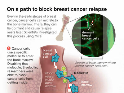 An infographic titled “On a path to block breast cancer relapse”. At top, a bone illustration emits an inset that shows dormant breast cancer cells inside of bone marrow. Below, a three-part diagram shows cancer cells entering bone marrow using the molecule E-selectin, a molecule anchoring the cancer cell, and a drug (plerixafor) ejecting the cells from the marrow.