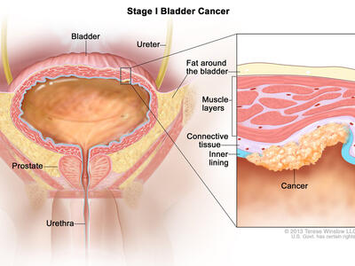 Illustration labeled “Stage I Bladder Cancer.” The main illustration labels the bladder, ureter, fat around the bladder, urethra, and prostate. A small cancer cluster inside of the muscle and fat layers of the bladder is linked to an inset illustration which labels the muscle layers, connective tissue, and inner lining of the bladder along with the actual cancer. 