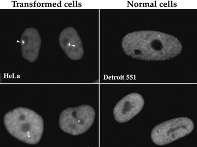 PNCs found in cancer cells (arrows) but not in normal cells.