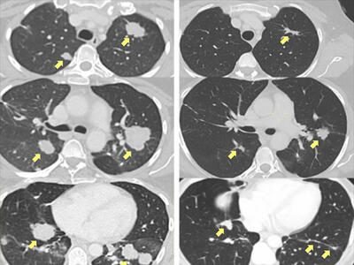 Side-by-side comparison of lung CT scans highlighting changes over time. The left column shows "Pre-Treatment" images with visible tumors indicated by yellow arrows. The right column shows scans "20 Months" post-treatment, with significant reduction in tumor size, as pointed out by the arrows.