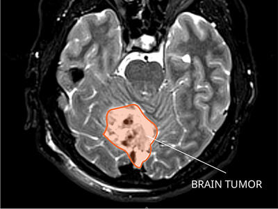 MRI of a mouse brain with a tumor.