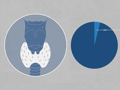 An illustration of a thyroid (in white) along with a larynx and trachea in blue. Next to it, an unlabeled pie chart. The pie chart has a smaller, medium-blue pie slice surrounded by a larger, dark-blue slice.
