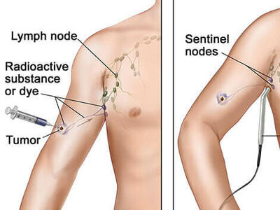 Illustration showing a three-step procedure for sentinel lymph node biopsy in skin cancer treatment. The first panel depicts an injection of a radioactive substance or dye near a tumor to identify lymph nodes. The second panel shows a probe detecting sentinel nodes. The third panel illustrates the removal of the sentinel nodes.
