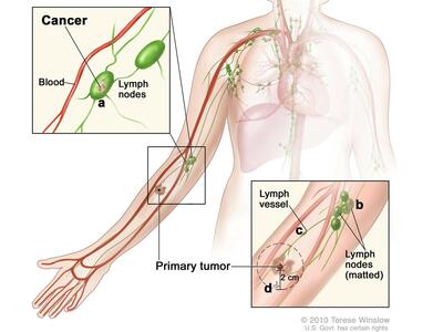Illustration of Stage III Melanoma. The image depicts the human body with a focus on the lymphatic and circulatory systems. A primary tumor is shown on the arm, with cancer spreading to nearby lymph nodes. Insets highlight cancer involvement in lymph nodes near blood vessels as well as lymph vessel proximity to the primary tumor. Labeled features include lymph vessels, matted lymph nodes, and a primary tumor measuring 2 cm.