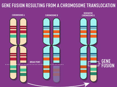 Image of three sets of chromosomes with gene fusion resulting from a chromosome translocation.