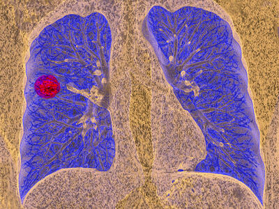 Una imagen de TC de una persona con cáncer de pulmón.