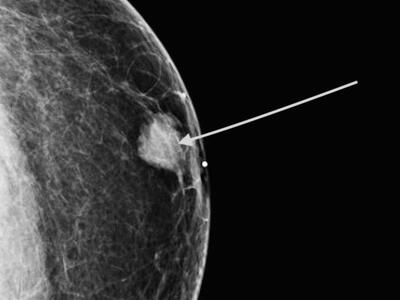 Mamografía diagnóstica muestra un tumor en el seno izquierdo de un paciente de sexo masculino.