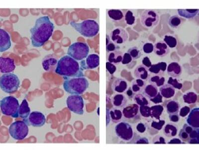 Preparaciones histopatológicas de un paciente con leucemia mieloide aguda recidivante con una mutación de FLT3 (izquierda) y después de remisión (derecha).