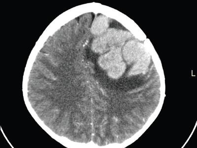 Exploración con tomografía computarizada (TC) de una recidiva tumoral en el cerebro de un niño con LLA.