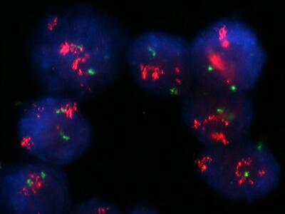 Una imagen de células de cáncer de seno con amplificación intensa de HER2.
