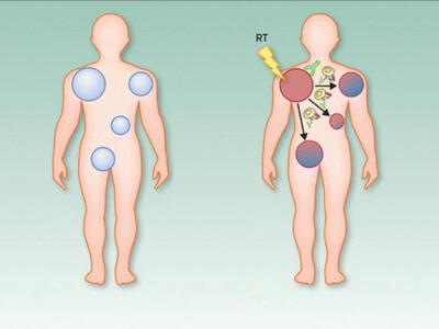 Una ilustración del efecto abscopal, que ocurre cuando la radiación, u otro tipo de terapia localizada, achica el tumor tratado, pero también achica los tumores en el cuerpo que no se trataron.
