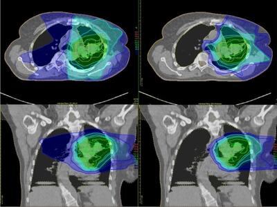 Scans of the chest after traditional radiation therapy and after proton therapy, which show how much surrounding tissue is affected by each type of therapy.