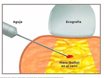 Ilustración de una biopsia con aguja gruesa.
