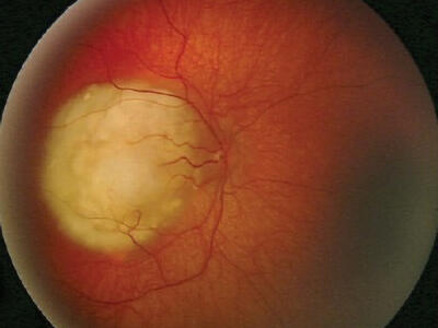 Retinoblastoma del ojo