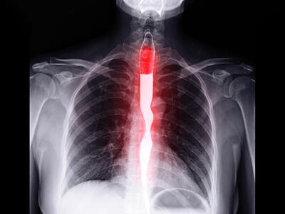 An x-ray of the esophagus shown with barium contrast.