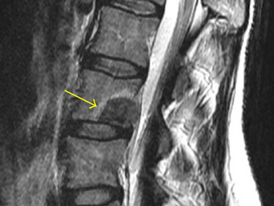 An image of an MRI showing a metastatic tumor in a patient's spine.