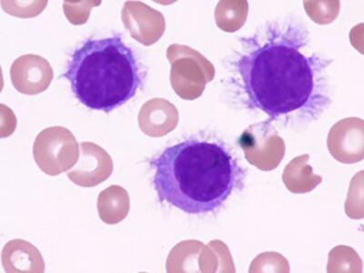 Microscopic image showing blood cells, including three hairy cell leukemia purple-stained cells with fuzzy edges, surrounded by numerous red blood cells with a soft pink hue.