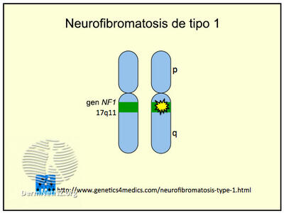 Ilustración de una mutación del gen NF1 en el cromosoma 17.