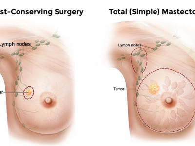 Side by side illustrations of breast-conserving surgery and a simple mastectomy.