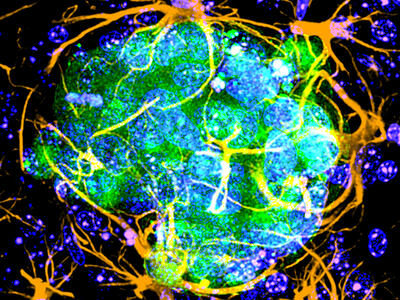 Melanoma cells in brain surrounded by astrocytes