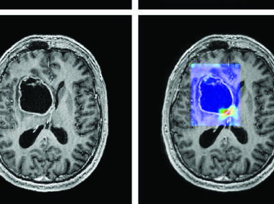 Image of cranial scan showing IDH1 mutant glioblastoma