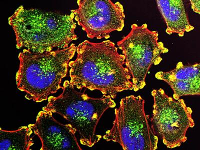 Células de cáncer metastásico