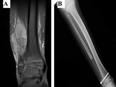 Side-by-side x-ray images. The left image is a close up of a fibula with a large tumor and the x-ray image itself is in shades of dark grey. The right image shows a lower leg with no tumor; the x-ray image is lighter grey and white compared to the left image.