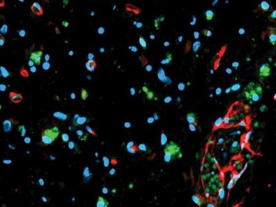 A fluorescence micrograph of glioma organoids.