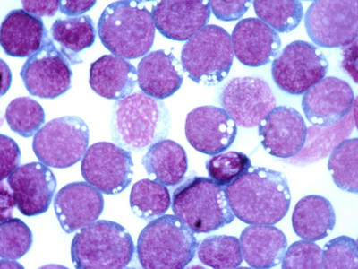 Hematoxylin and eosin (HE) staining of the Epstein-Barr virus (EBV).