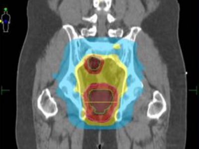 An IMRT dosing plan for an adult with rectal cancer