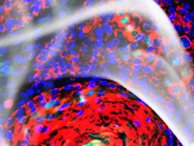 High-Risk Papilloma Cells overlaid with a wisp of smoke