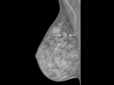 Una mamografía que indica con flechas una asimetría en la zona superior de la mama.