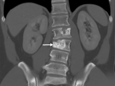 A CT scan showing a metastatic tumor embedded in a spinal vertabrae