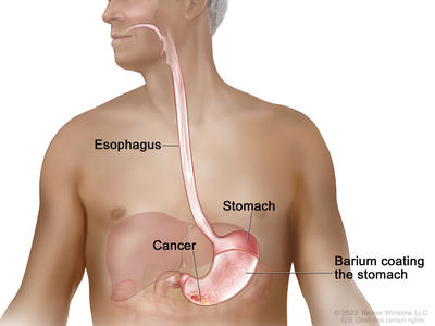 Barium swallow; drawing shows barium liquid flowing down the esophagus and into the stomach. The barium coats and outlines the inside of the esophagus and stomach. Also shown is cancer in the stomach.