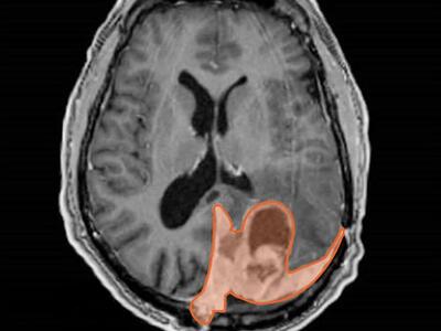 Resonancia magnética de encéfalo en la que se marca un meningioma en color naranja.