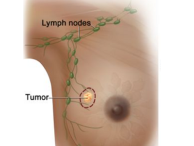 An illustration of a small tumor in a breast and nearby lymph nodes in the armpit.