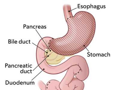Two medical illustrations of gastrointestinal anatomy. One illustration shows normal GI anatomy with dotted lines where incisions are made during total gastrectomy surgery, and the other shows GI anatomy after a total gastrectomy.