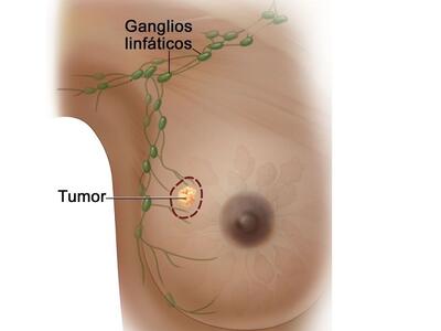 Imagen de una mama (seno) que muestra un tumor y la ubicación de los ganglios linfáticos cercanos.