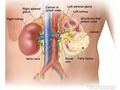 An anatomic illustration of stage 3 kidney cancer