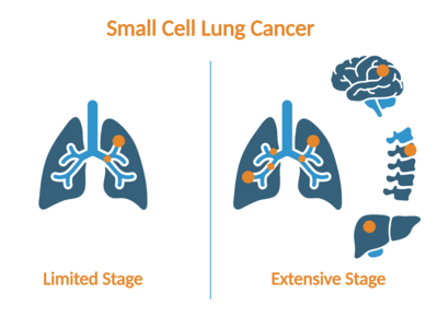 Icons of organs showing that limited stage lung cancer is limited to one side of the lungs while extensive stage lung cancer is in both sides of the lungs and other organs like the brain, bone, and liver.