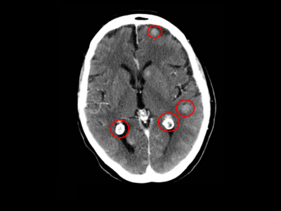 Tomografía con vista transversal de la cabeza de una persona que muestra cuatro metástasis en el encéfalo (marcadas con círculos rojos).