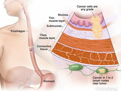 anatomic illustration of stage 2b esophageal cancer, with pop out of cancer cells in nearby lymph nodes 