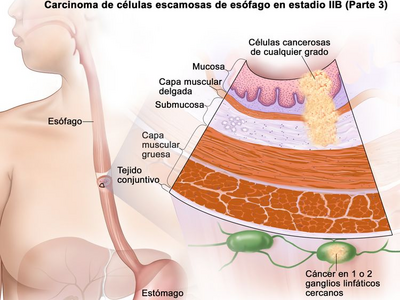 Ilustración anatómica del cáncer de esófago en estadio 2b, con un primer plano de ganglios linfáticos cercanos donde hay cáncer.