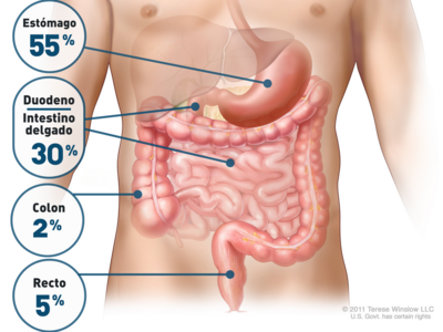 Imagen anatómica que indica la frecuencia con que se encuentran los tumores de estroma gastrointestinal (TEGI) en el aparato digestivo.