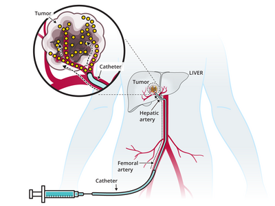 An illustration of a catheter delivering a drug via the femoral artery into a tumor contained within the liver. An inset shows an enlarged view of the tumor, the catheter, and the drug entering the tumor via veins. 