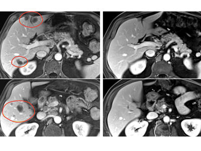 Four scans show before and after images of liver metastases shrinking after treatment with selected TIL therapy and pembrolizumab.