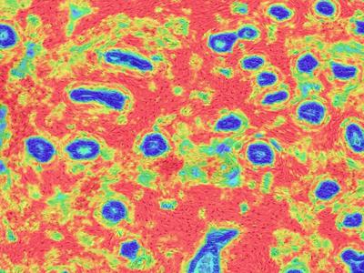 Breast tissue showing substantial changes. 