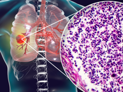 3D illustration of an upper torso showing spine, lungs, and heart. A popup image of lung cancer shows what a cancerous tumor looks like under a microscope.