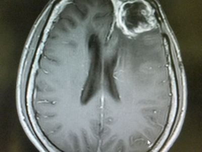 Magnetic resonance image of glioblastoma, shown as a large mass on the upper right-hand side of the brain.